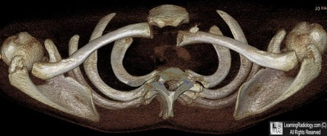 posterior sc dislocation